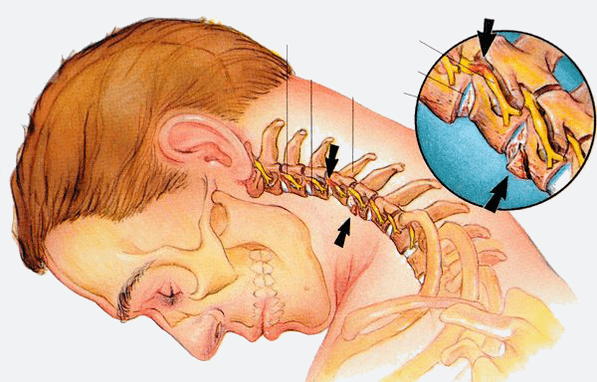 Etapas da osteocondrose da columna cervical